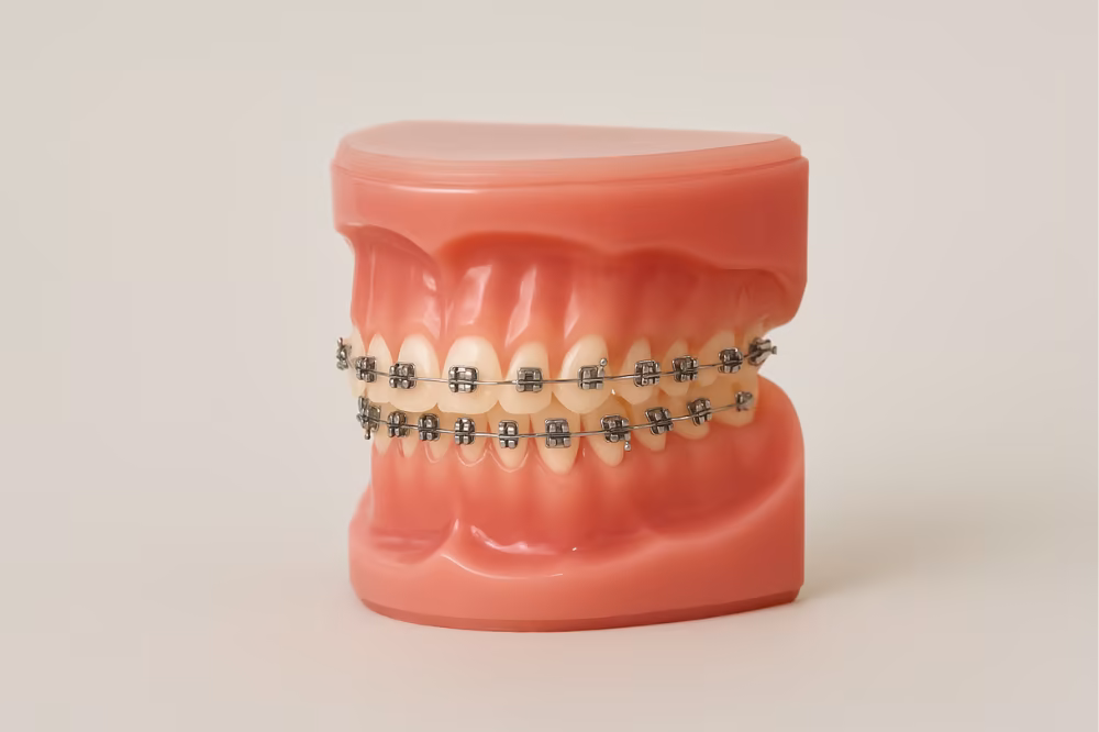 How to Choose Between Braces and Invisalign at Valle Smiles